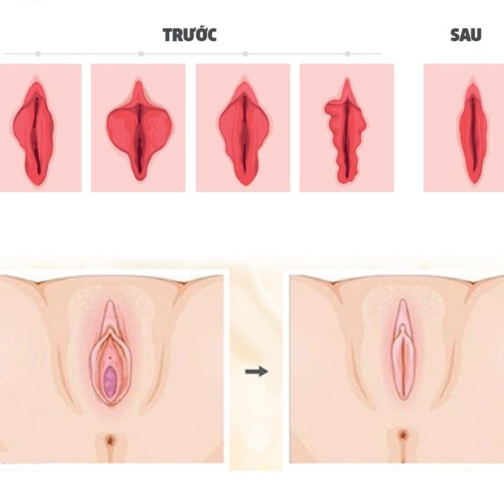 Trẻ hóa vùng kín có ảnh hưởng sinh lý hay sinh sản không? 4 Trẻ hóa vùng kín có ảnh hướng gì đến sinh sản không