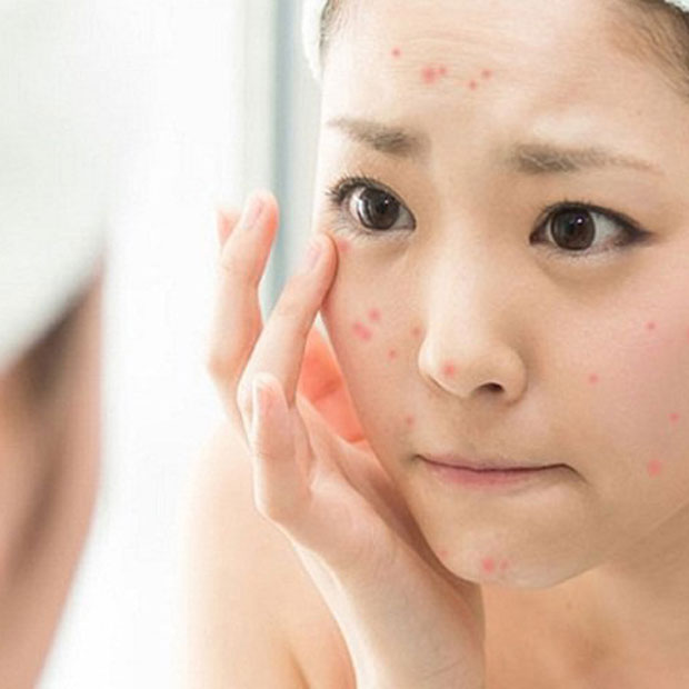 trị mụn tuổi dậy thì trị mụn tuổi dậy thì