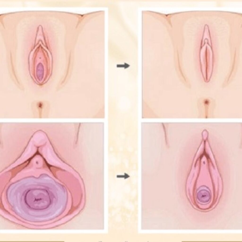 Có nên trẻ hóa vùng kín