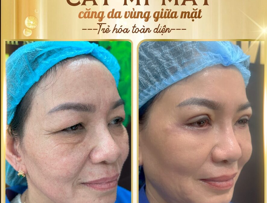 Cắt Mí Mắt Tại Cần Thơ – Sở Hữu Đôi Mắt Hai Mí Tự Nhiên, Trẻ Trung