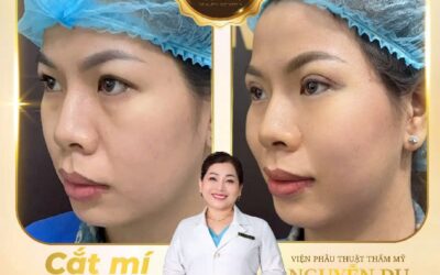 Cắt Mí Mắt Tại Cần Thơ – Sở Hữu Đôi Mắt Hai Mí Tự Nhiên, Trẻ Trung