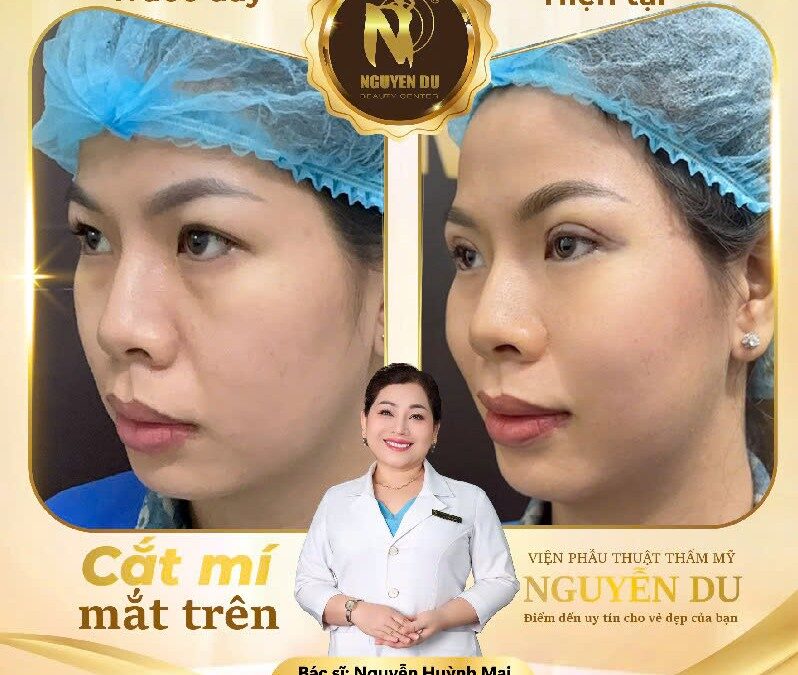 Cắt Mí Mắt Tại Cần Thơ – Sở Hữu Đôi Mắt Hai Mí Tự Nhiên, Trẻ Trung