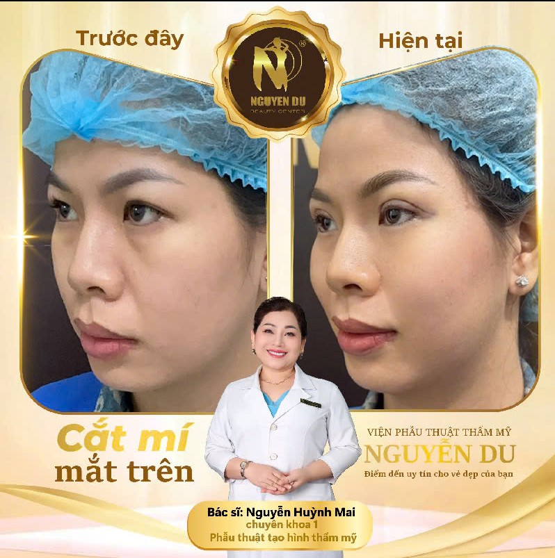 cắt mí mắt tại Cần Thơ