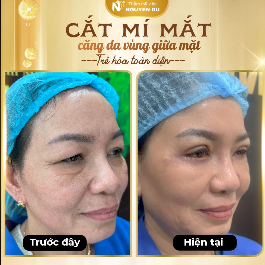 Cắt Mí Mắt Tại Cần Thơ – Sở Hữu Đôi Mắt Hai Mí Tự Nhiên, Trẻ Trung 1 cắt mí mắt tại Cần Thơ