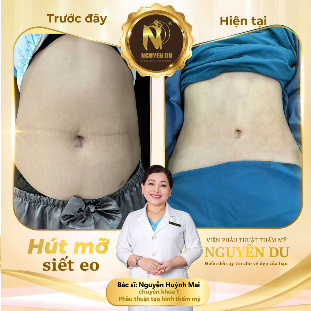 Hút Mỡ Bụng Tại Cần Thơ: Chi Phí Bao Nhiêu?