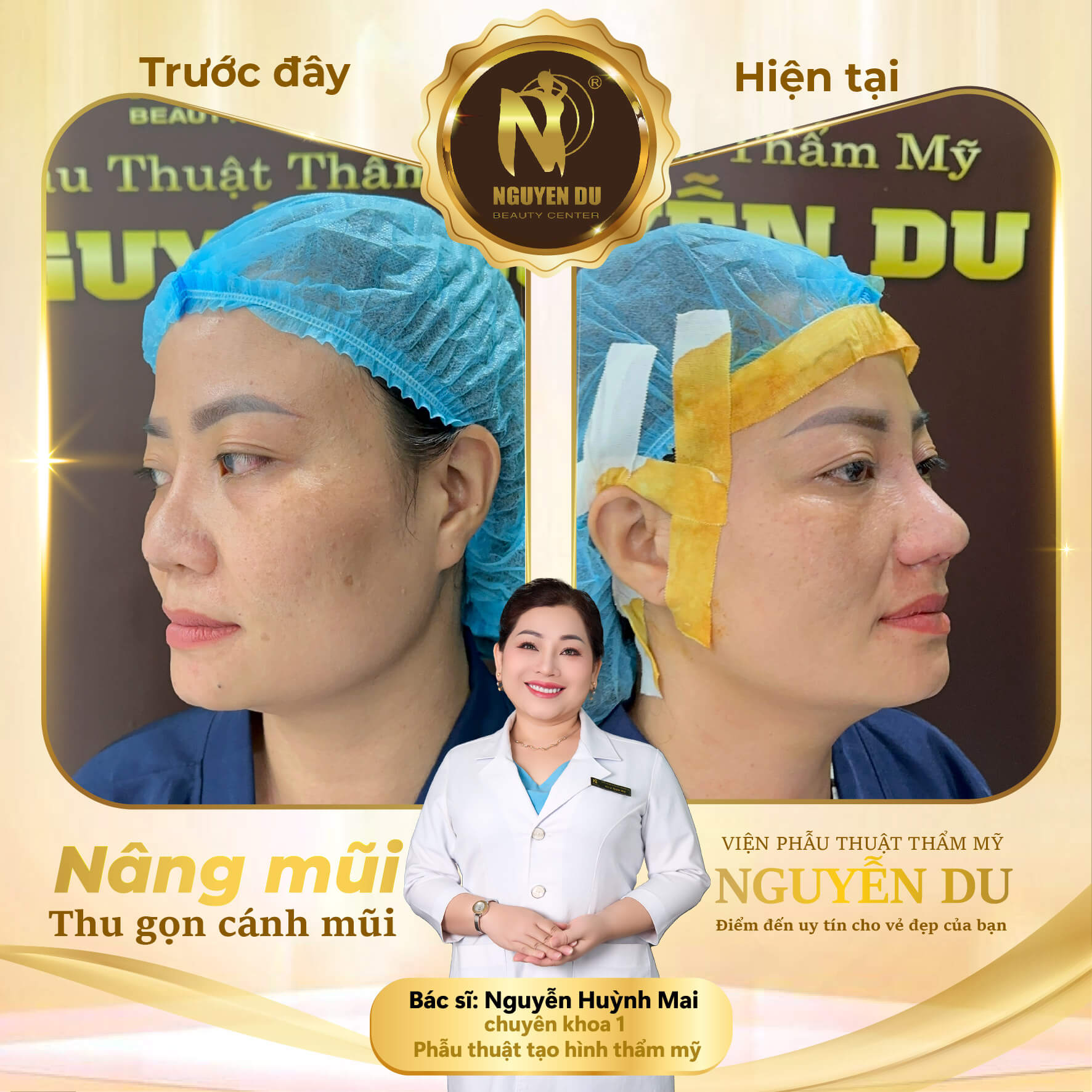 Nâng Mũi Tại Cần Thơ Giá Bao Nhiêu? Bảng Giá Mới Nhất 