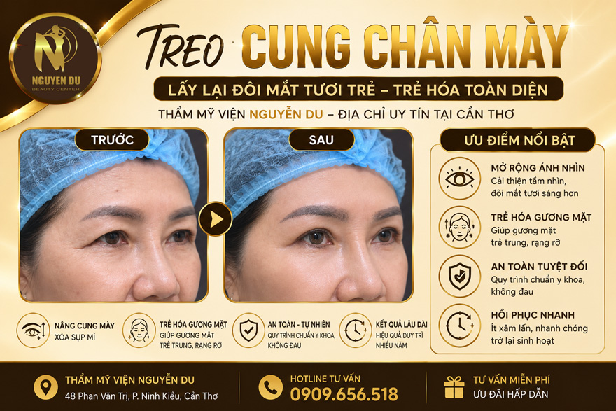 Treo Cung Chân Mày Ở Cần Thơ – Trẻ Hóa Gương Mặt Về Tuổi 18 1 Treo Cung Chân Mày Ở Cần Thơ – Trẻ Hóa Gương Mặt Về Tuổi 18
