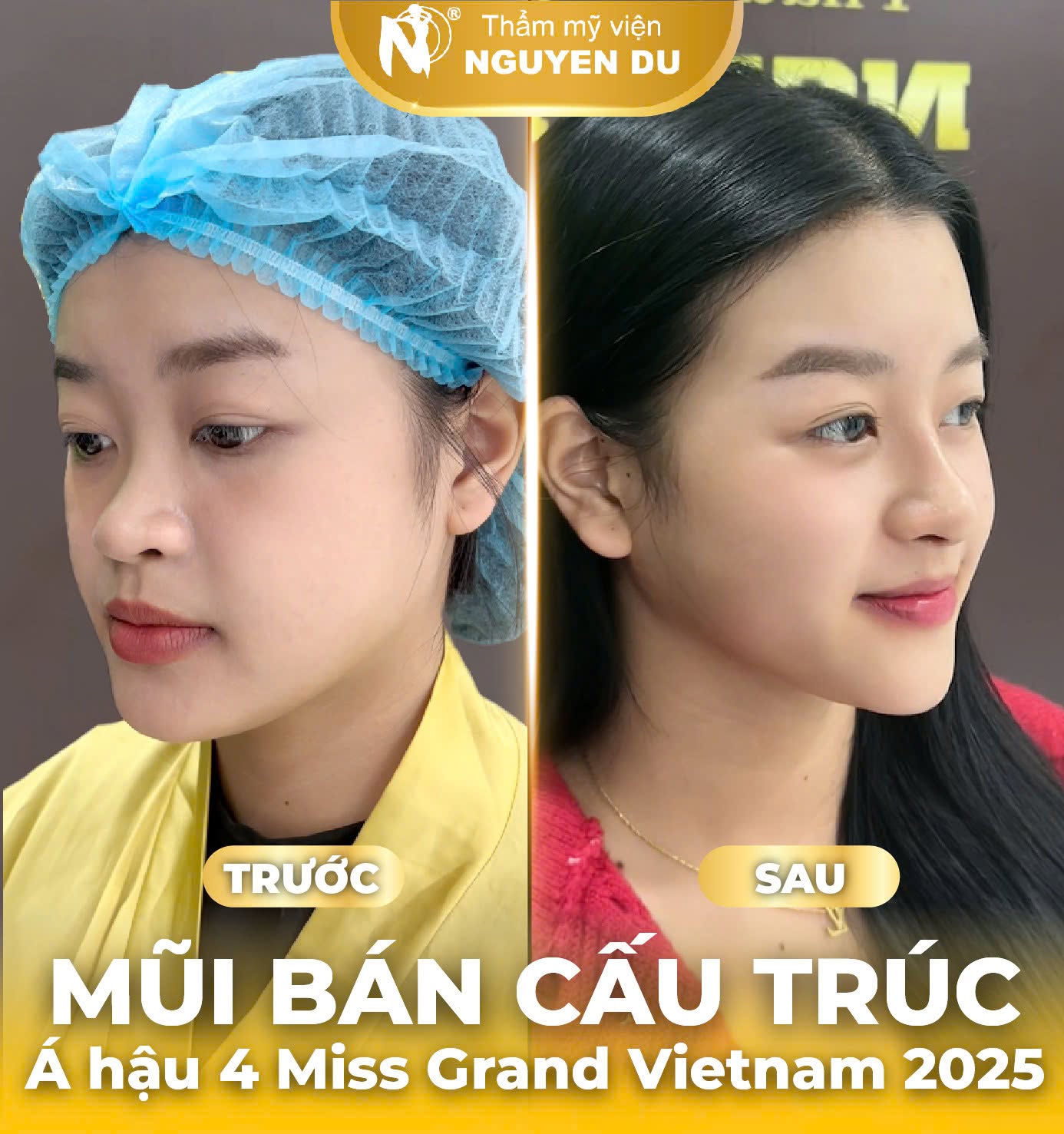 Á Hậu Miss Grand - Lan Ngọc Phương Anh làm thẫm mỹ nâng mũi tại Nguyễn Du Á Hậu Miss Grand - Lan Ngọc Phương Anh làm thẫm mỹ nâng mũi tại Nguyễn Du