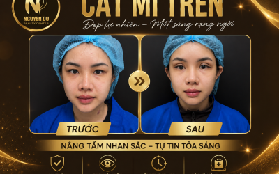 Cắt Mí Trên Giá Bao Nhiêu? Cập Nhật Chi Phí Mới Nhất