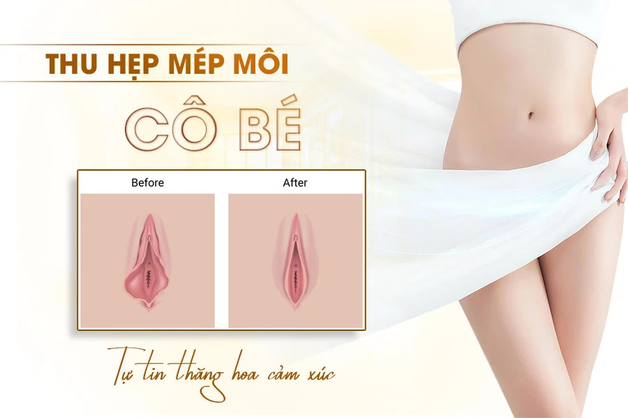 Cắt Môi Cô Bé Giá Bao Nhiêu Tiền? Bảng Giá Mới Nhất 2026 2 cắt môi cô bé