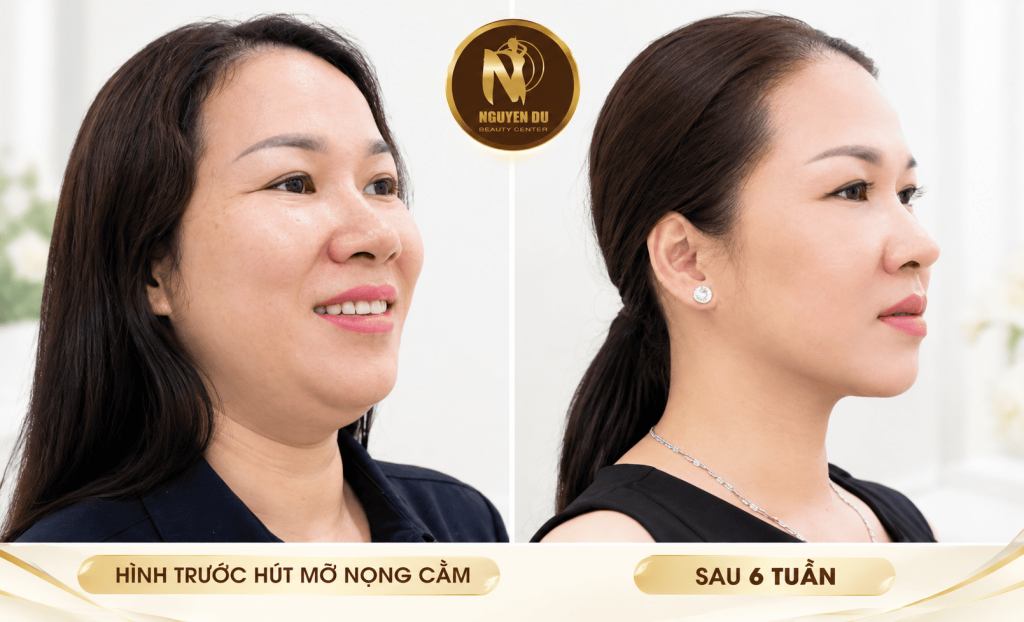 Hút Mỡ Nọng Cằm Cần Thơ: Giá Bao Nhiêu?