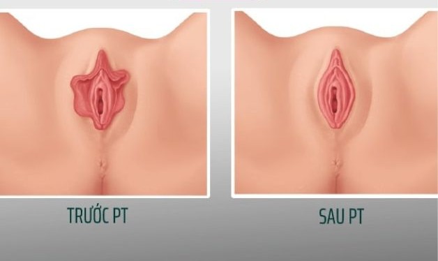 phẫu thuật thu nhỏ cô bé