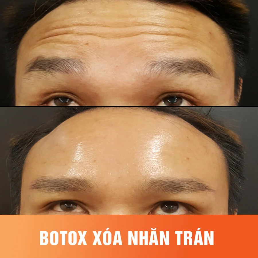tiêm botox xóa nhăn trán