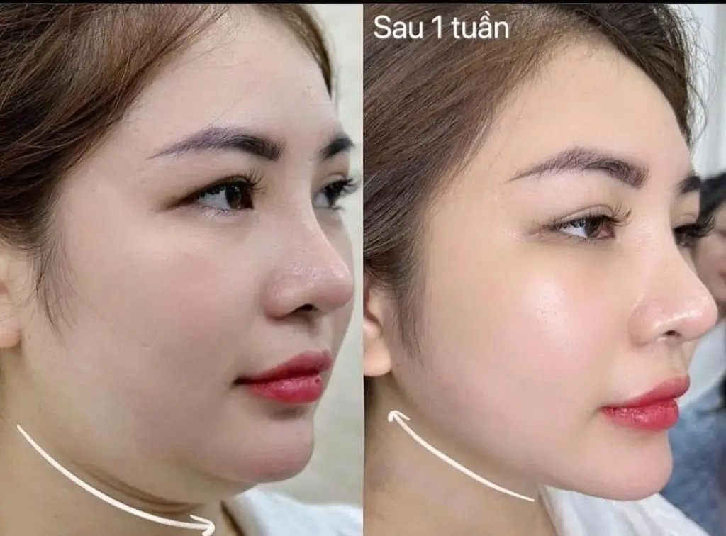 Hút Mỡ Nọng Cằm Giá Bao Nhiêu Tiền? Giải Đáp Chi Tiết Từ Chuyên Gia 2 Tiêm Tan Mỡ Nọng Cằm Giá Bao Nhiêu?