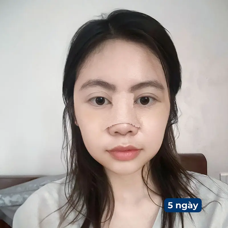 Nâng Mũi Cấu Trúc Bao Lâu Thì Hết Sưng? Giải Đáp Chi Tiết 3 Nâng mũi cấu trúc bao lâu thì hết sưng