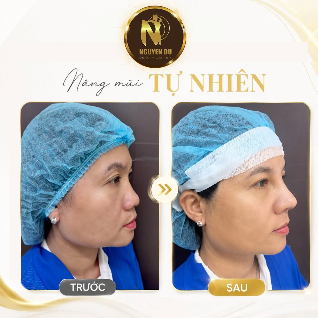 Giá Nâng Mũi Thẩm Mỹ Viện Nguyễn Du Cần Thơ Mới Nhất 3 anh truoc nang mui tu nhien