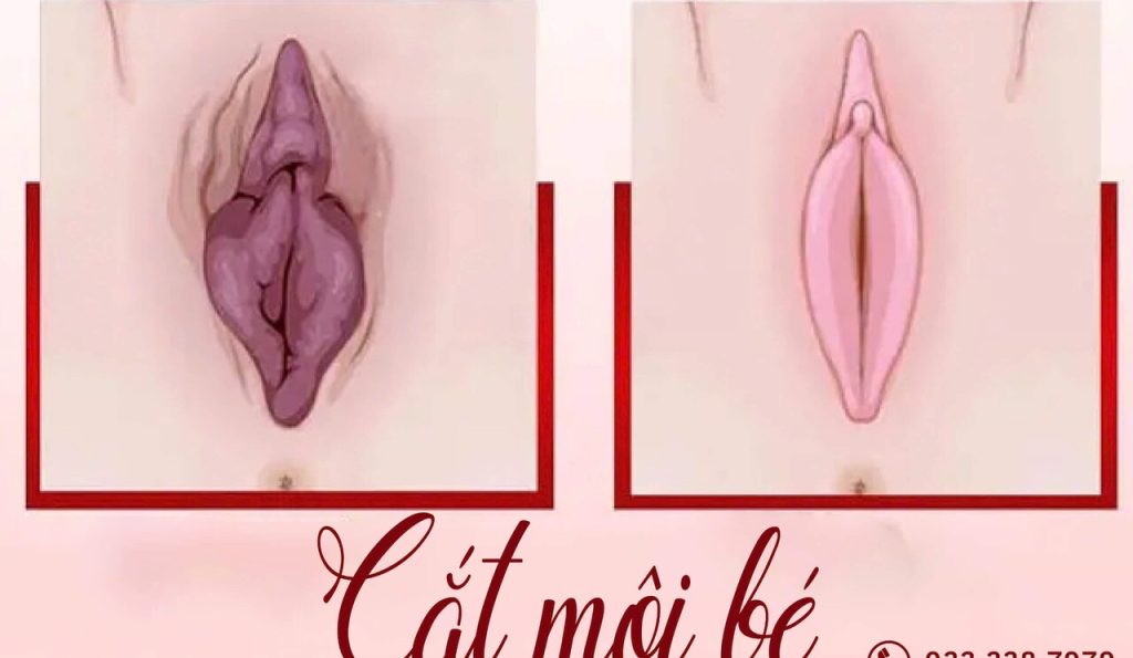 Cắt Môi Bé Vùng Kín Có Nên Không? Giá Và Những Điều Cần Biết 3 cắt môi bé - giá cắt môi cô bé