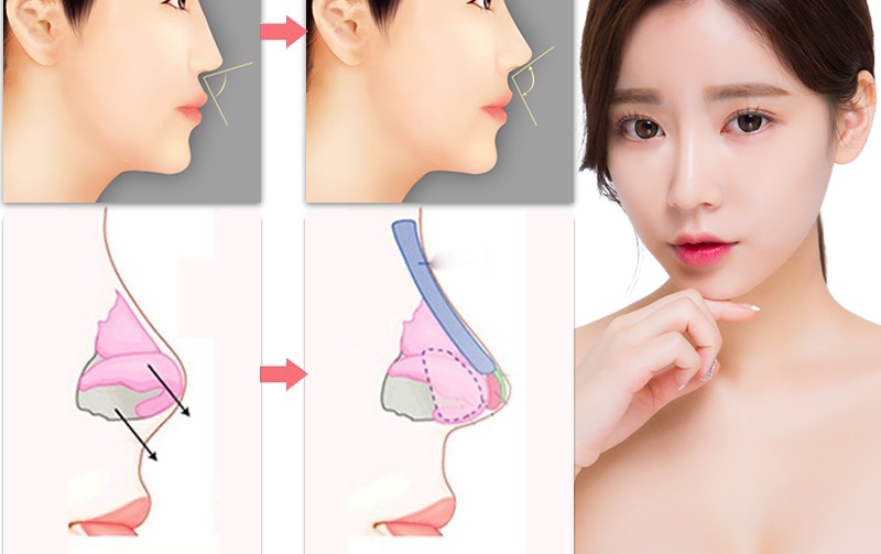 Nâng Mũi Cấu Trúc Bao Lâu Thì Hết Sưng? Giải Đáp Chi Tiết 2 Nâng mũi bao lâu thì lành