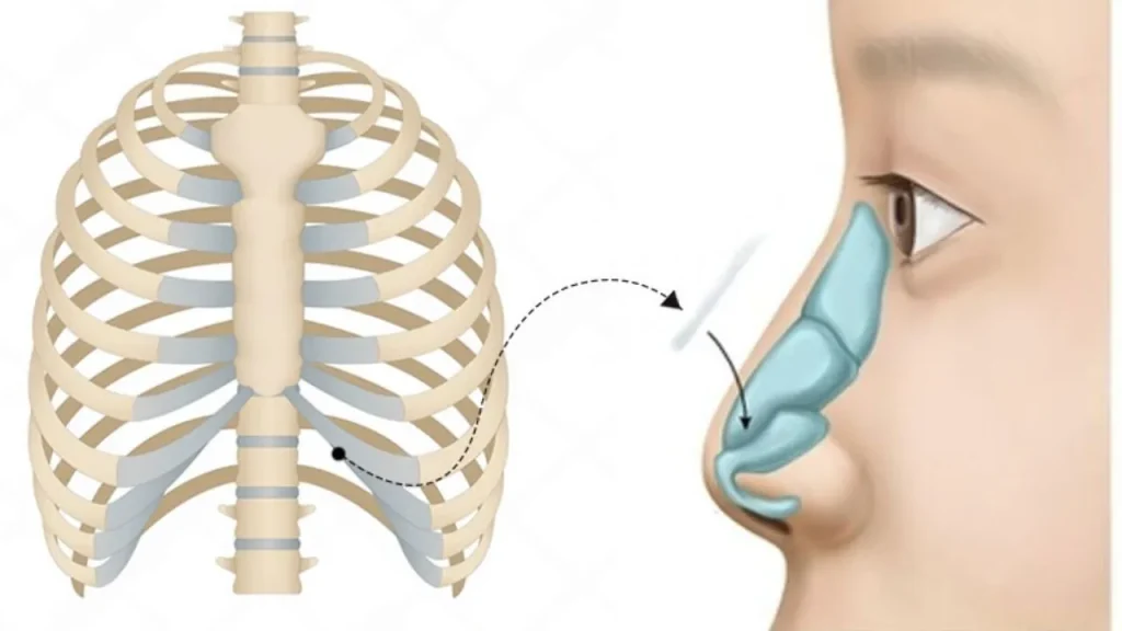 Nâng Mũi Cấu Trúc Sụn Sườn: Ưu Nhược Điểm & Chi Phí 2 nâng mũi sụn sườn là gì