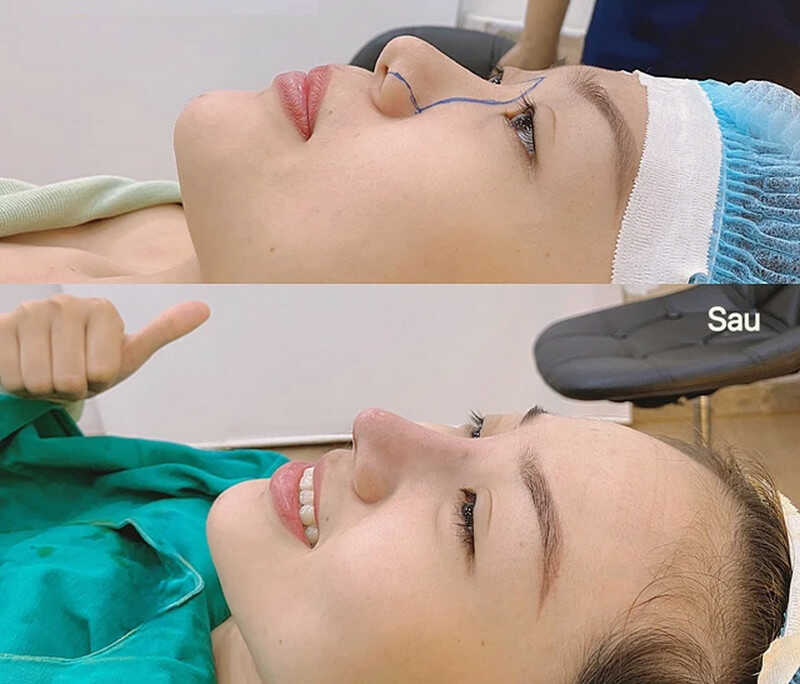 Nâng Mũi Sụn Sườn Giá Bao Nhiêu? Chi Phí Chi Tiết 3 Ảnh trước sau - nâng mũi sụn sườn