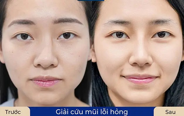 sửa mũi hỏng