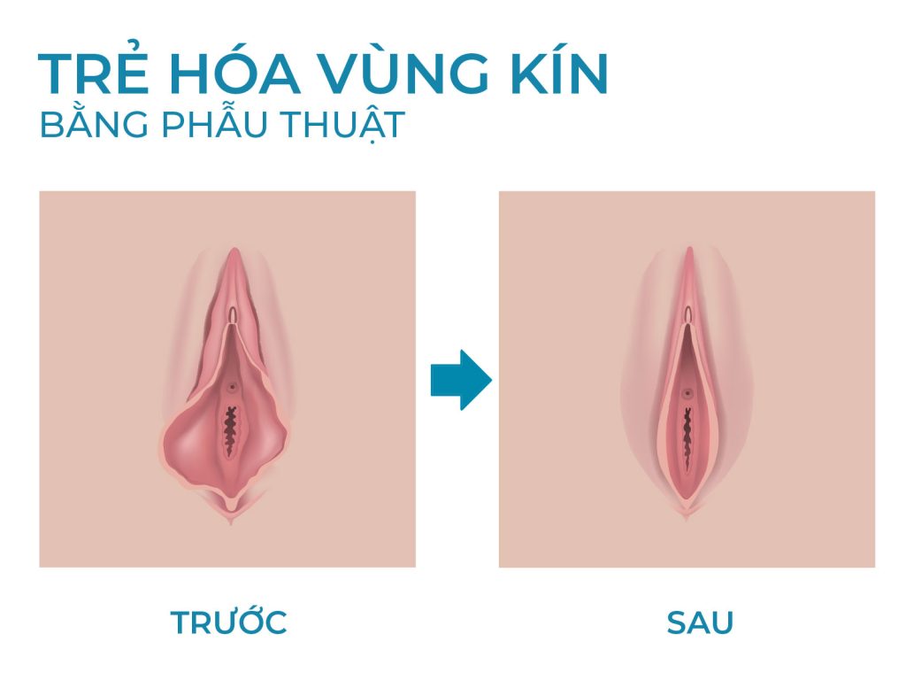 giá thẩm mỹ vùng kín - review thẩm mỹ cô bé